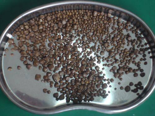 结石的图片,形态、分布与成因揭秘