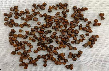 结石的图片,形态、分布与成因揭秘