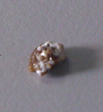 结石的图片,形态、分布与成因揭秘