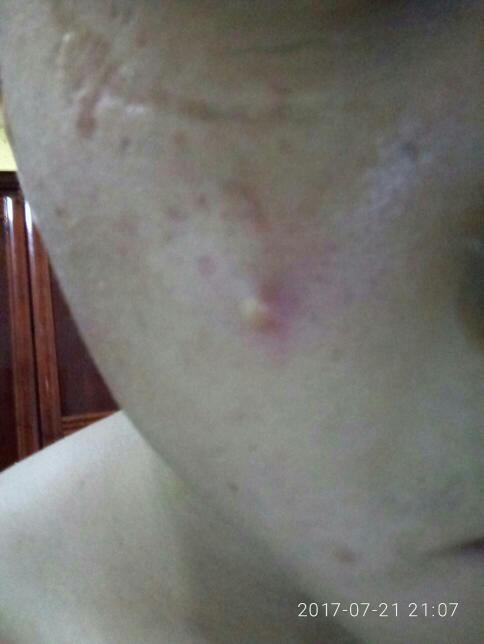 脸上长肿瘤早期图片,早期脸部肿瘤识别与预防指南