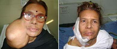 脸上长肿瘤早期图片,早期脸部肿瘤识别与预防指南