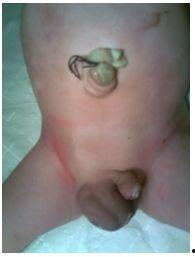 小儿腹股沟疝气图片,图片解析与症状识别