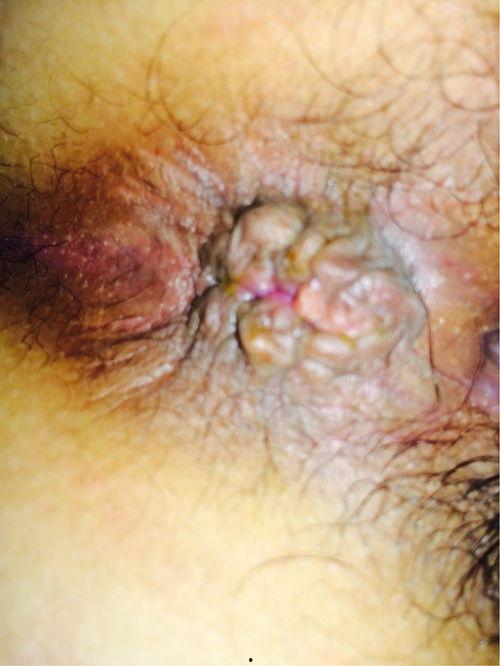 蜂窝疮图片,揭秘皮肤病的神秘面纱