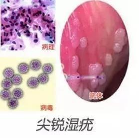 女性尖锐湿疣初期图片