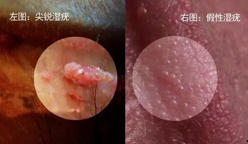 女性尖锐湿疣初期图片