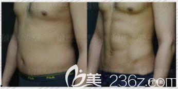 韩国腹肌整形,打造完美腹肌的艺术之旅