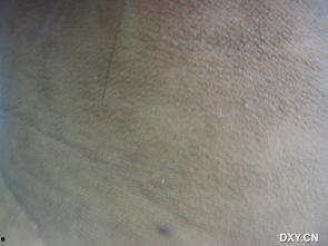 黑皮症图片,揭秘皮肤病变的神秘面纱