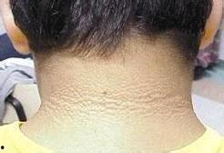 黑皮症图片,揭秘皮肤病变的神秘面纱