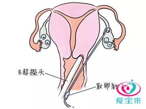 做试管婴儿视频,从视频看辅助生殖技术