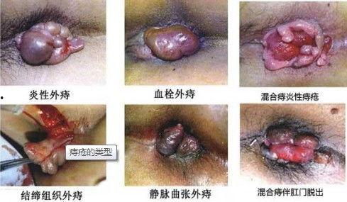 女外痔疮图片大全,女性外痔疮图片解析与防治知识