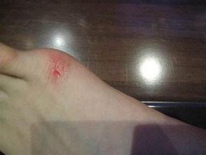 脚膝盖受伤的图片大全,常见类型与康复要点