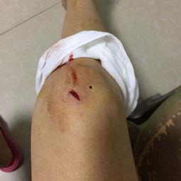 脚膝盖受伤的图片大全,常见类型与康复要点