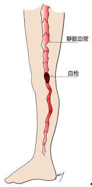 下肢深静脉血栓图片,影像学特征与诊断要点解析