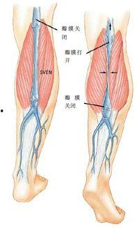 下肢深静脉血栓图片,影像学特征与诊断要点解析