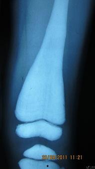 石骨症图片,罕见骨骼疾病的影像学特征解析