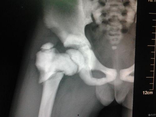 石骨症图片,罕见骨骼疾病的影像学特征解析