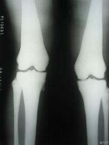 石骨症图片,罕见骨骼疾病的影像学特征解析